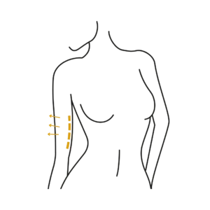 Woman's body illustration highlighting the location of the Armlift surgery