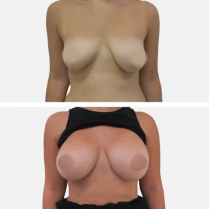 تكبير الثدي تكبير الصدر تجميل الثدي تجميل الصدر